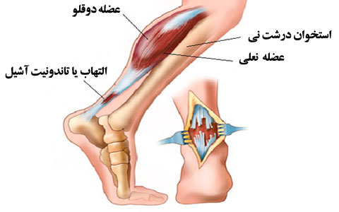 التهاب تاندون آشیل، علت، علائم، پیشگیری و درمان 7 التهاب تاندون آشیل