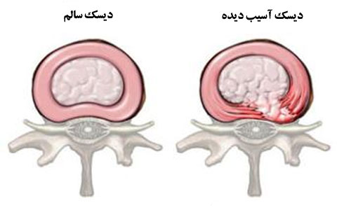 آسیب دیسک ناحیه پشت آسیب دیسک ناحیه پشت