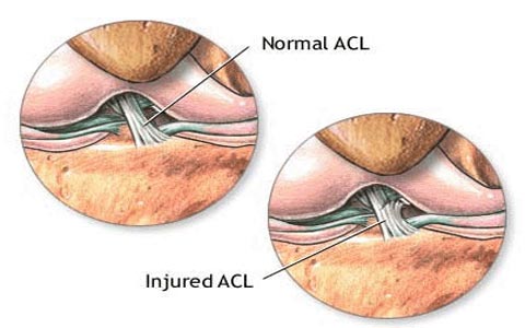 آسیب رباط صلیبی ACL یا قدامی آسیب رباط صلیبی ACL یا قدامی