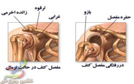 دررفتگی شانه