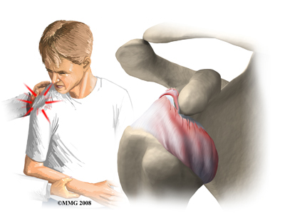 دررفتگی شانه دررفتگی شانه