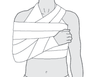 دررفتگی شانه دررفتگی شانه
