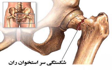 شكستگی سر استخوان ران 3 Hip-fracture