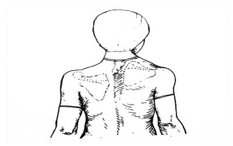 تغییر شکل بالا بودن استخوان کتف 3 High-scapula-1-elmevarzesh