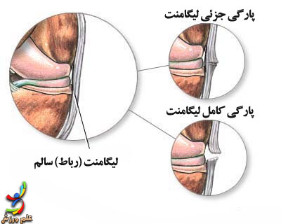پاسخ بافت های مختلف بدن به آسیب های حاد 4 Ligament-rupture-elmevarzesh