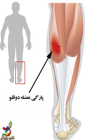 پاسخ بافت های مختلف بدن به آسیب های حاد 5 Muscle-tear-elmevarzesh