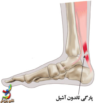 پارگی حاد رباط ، تاندون و عضله 6 Tendon-rupture-elmevarzesh