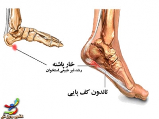 فاشئیت پلانتار (التهاب تاندون کف پا)+پیشگیری و درمان 7 فاشئیت پلانتار