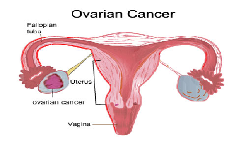 ارتباط مصرف گوشت و چربی با ایجاد سرطان تخمدان 3 ovarian-cancer-elmevarzesh