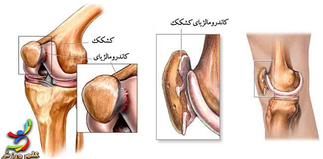 دررفتگی و شکستگی کشکک 6 chondromalacia-patellar-1-elmevarzesh