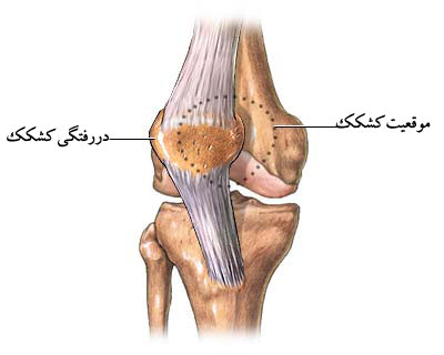 دررفتگی و شکستگی کشکک 5 knee-dislocation-elmevarzesh