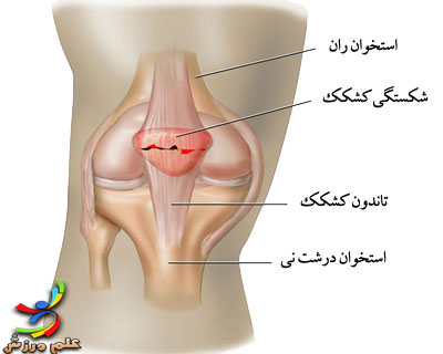 دررفتگی و شکستگی کشکک 7 patella-Fracture--elmevarzesh