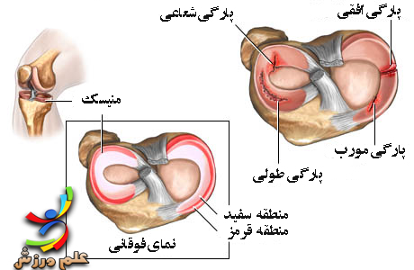 آسیب های مینیسک زانو آسیب های مینیسک زانو