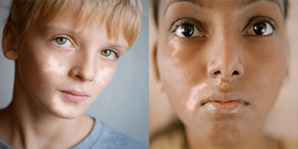 علائم و نشانه های بیماری های رایج پوستی 5 بیماری های رایج پوستی
