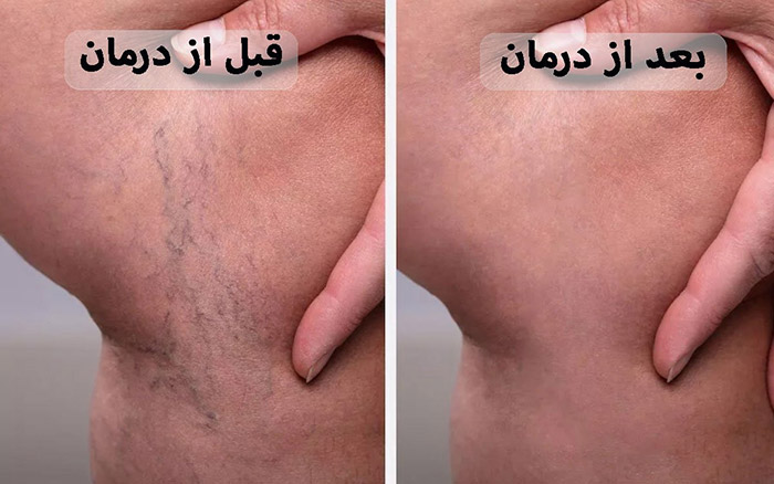 واریس را با یک تزریق ساده درمان کنید! 5 قبل و بعد از درمان واریس عنکبوتی ساق پا