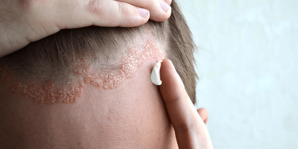علائم و نشانه های بیماری های رایج پوستی 6 بیماری های رایج پوستی