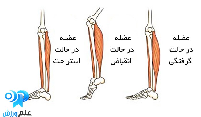 همه چیز در مورد علت گرفتگی عضلات، پیشگیری و درمان گرفتگی 11 گرفتگی عضلانی