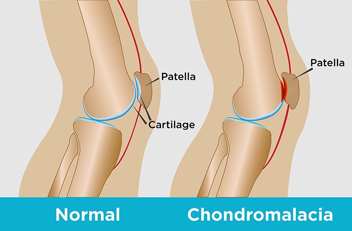 علت صدا دادن مفاصل چیست؟ چگونه درمان میشود؟ 11 chondromalacia