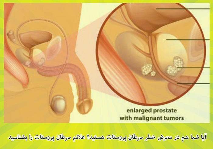 آیا شما هم در معرض خطر سرطان پروستات هستید؟ 4 سرطان پروستات