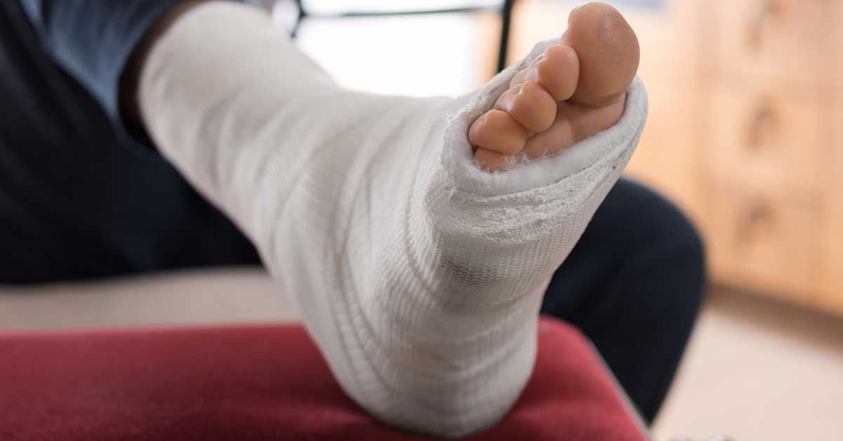 همه چیز درباره پیچ خوردگی مچ پا - علت، علائم و روش درمان 14 گچ گرفتن پیچ خوردگی مچ پا